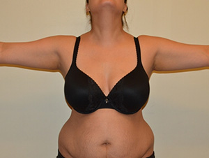 Liposuction Case 6721 Before Photo Liposuction