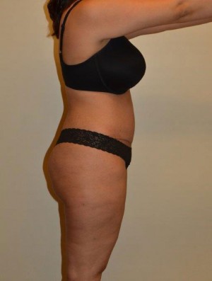 Liposuction Case 6721 After Photo Liposuction