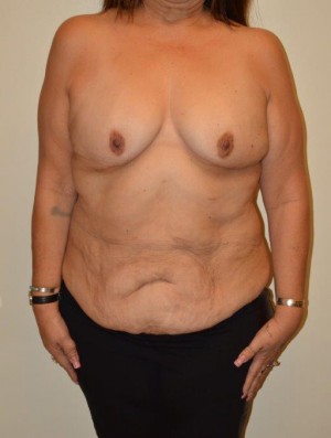 Breast Reconstruction Case 6829 Before Photo Breast Reconstruction