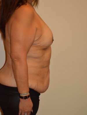 Breast Reconstruction Case 6829 Before Photo Breast Reconstruction