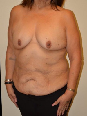 Breast Reconstruction Case 6829 Before Photo Breast Reconstruction