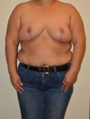 Breast Reduction Case 6838 After Photo Breast Reduction
