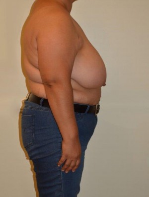 Breast Reduction Case 6838 Before Photo Breast Reduction