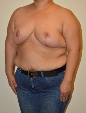 Breast Reduction Case 6838 After Photo Breast Reduction