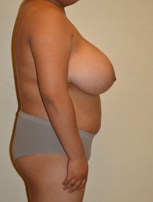 Breast Reduction Case 6846 Before Photo Breast Reduction