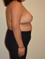 Breast Reduction