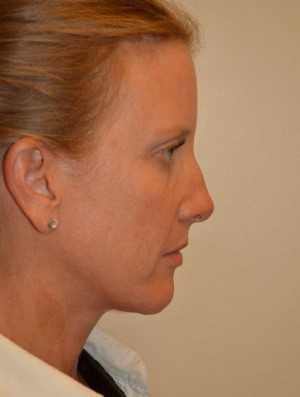 Nose Surgery Case 6864 Before Photo Nose Surgery