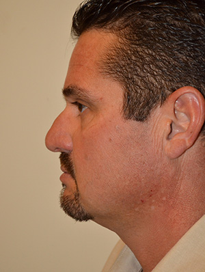 Nose Surgery Case 6652 Before Photo Nose Surgery