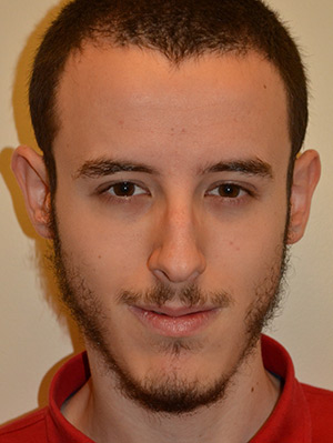 Nose Surgery Case 6621 Before Photo Nose Surgery
