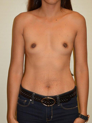 Breast Augmentation Case 6499 Before Photo Breast Augmentation