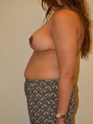 Breast Lift Case 6697 After Photo Breast Lift