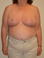 Breast Reduction