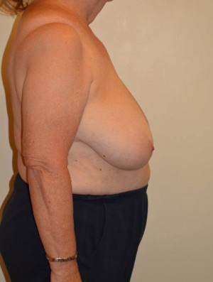 Breast Reduction Case 6681 Before Photo Breast Reduction