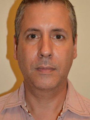 Facial Fat Grafting Case 6689 After Photo Facial Fat Grafting