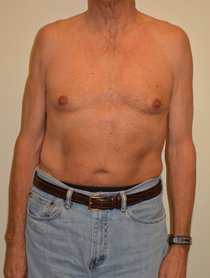 Gynecomastia Case 6784 Before Photo Gynecomastia