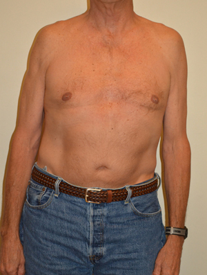 Gynecomastia Case 6784 After Photo Gynecomastia