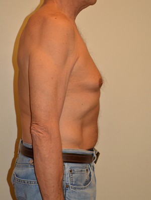 Gynecomastia Case 6784 Before Photo Gynecomastia