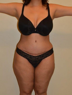 Tummy Tuck Case 6713 After Photo Tummy Tuck