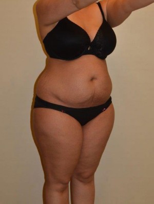 Tummy Tuck Case 6713 Before Photo Tummy Tuck