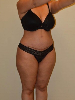Tummy Tuck Case 6713 After Photo Tummy Tuck