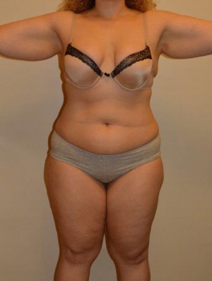 Liposuction Case 12907 Before Photo Liposuction