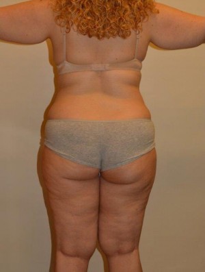 Liposuction Case 12907 Before Photo Liposuction