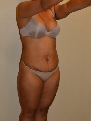 Tummy Tuck Case 12917 Before Photo Tummy Tuck