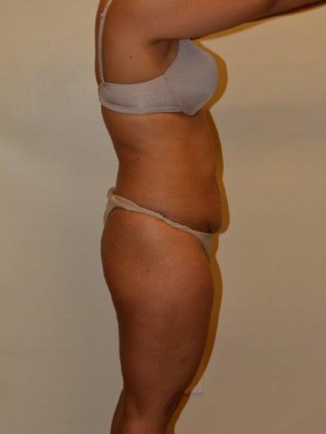 Buttock Augmentation Case 12925 Before Photo Buttock Augmentation