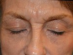 Eyelid Surgery