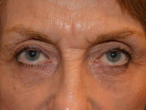 Eyelid Surgery