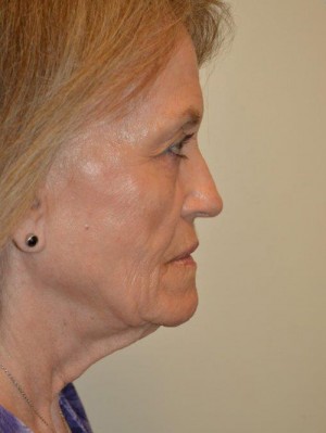 Facelift and Necklift Case 12939 Before Photo Facelift and Necklift