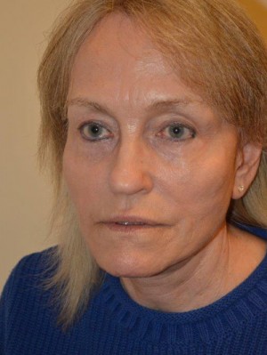 Facelift and Necklift Case 12939 After Photo Facelift and Necklift