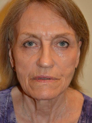 Facelift and Necklift Case 12939 Before Photo Facelift and Necklift
