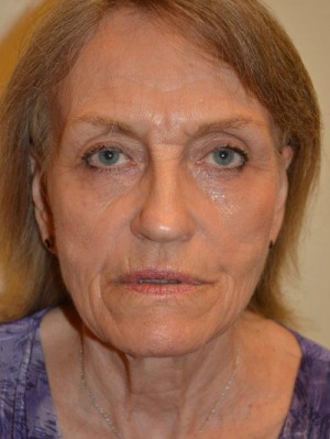 Facelift and Necklift