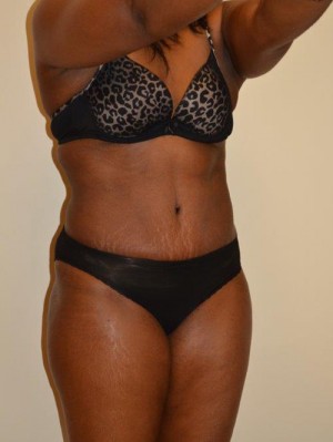 Tummy Tuck Case 12955 After Photo Tummy Tuck