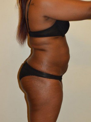 Tummy Tuck Case 12955 Before Photo Tummy Tuck