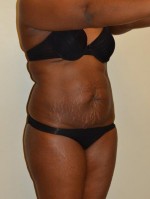 Tummy Tuck