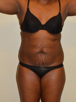 Tummy Tuck Case 12955 Before Photo Tummy Tuck