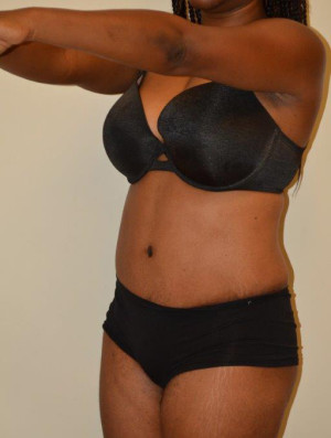 Tummy Tuck Case 12963 After Photo Tummy Tuck