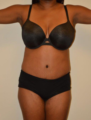 Tummy Tuck Case 12963 After Photo Tummy Tuck