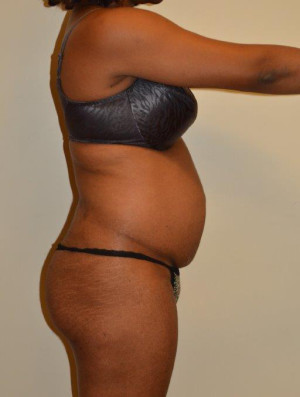 Tummy Tuck Case 12963 Before Photo Tummy Tuck