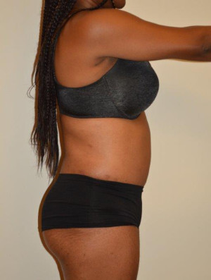 Tummy Tuck Case 12963 After Photo Tummy Tuck
