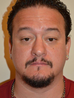 Nose Surgery Case 12973 After Photo Nose Surgery