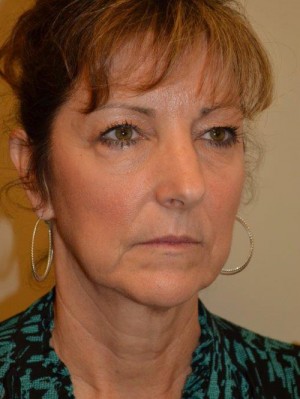 Facelift and Necklift Case 12991 Before Photo Facelift and Necklift