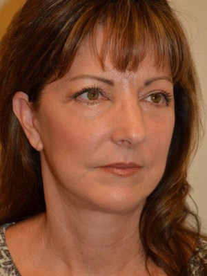 Facelift and Necklift Case 12991 After Photo Facelift and Necklift