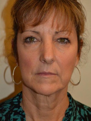 Facelift and Necklift Case 12991 Before Photo Facelift and Necklift