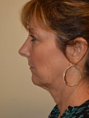 Facelift and Necklift Case 12991 Before Photo Facelift and Necklift