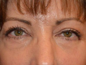 Eyelid Surgery Case 12992 After Photo Eyelid Surgery