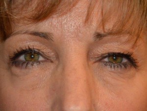 Eyelid Surgery Case 12992 Before Photo Eyelid Surgery