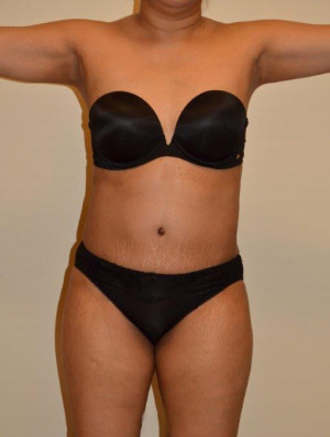 Tummy Tuck